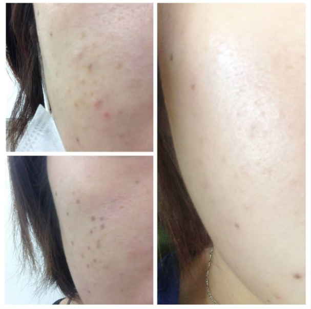 ビフォアー写真